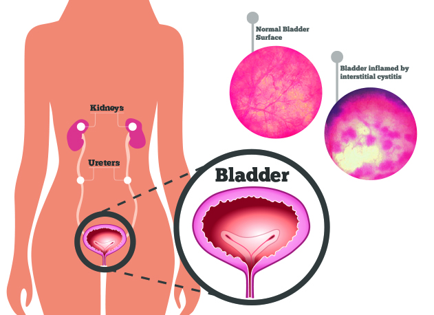 Interstitial Cystitis Women S Health Specialists