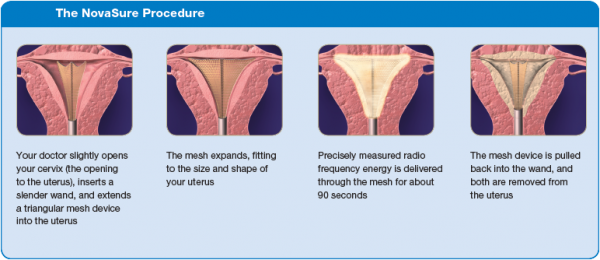 endometrial-ablation-women-s-health-specialists